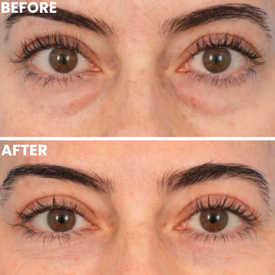 Hydrolyzed Collagen Eye Masks with Honeycomb Technology